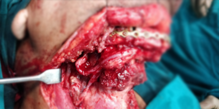 Jaw Bone Cancer Treatment